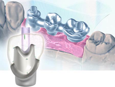 exocad módulo implantes