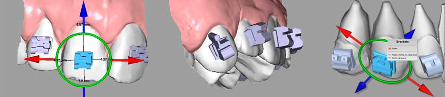 ortho studio modulo brackets